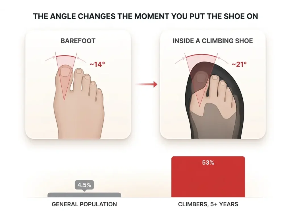 Infographic showing foot angle barefoot versus inside a climbing shoe with bunion prevalence data for climbers